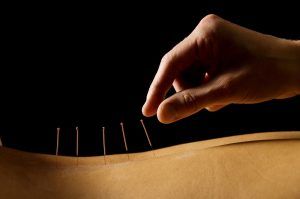Beneficios de la acupuntura para la salud